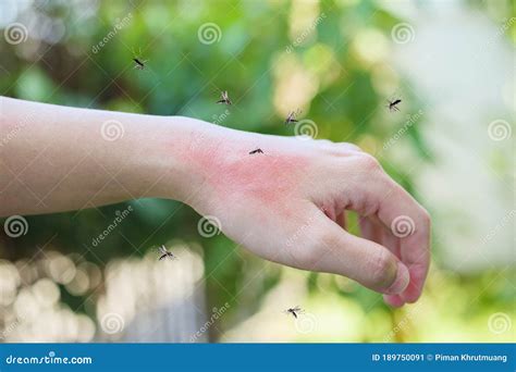 Mosquitoes Bite On Adult Hand Made Skin Rash And Allergy Stock Image