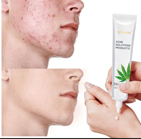 Acne Scar Remove Dark Spot Remover Lotion Acne Clearing Calming Skin C