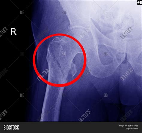 Hip Fracture Xray Image And Photo Free Trial Bigstock