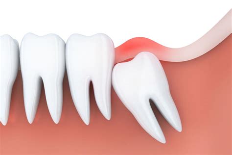 Wisdom Teeth Extraction Treatment And Aftercare Home