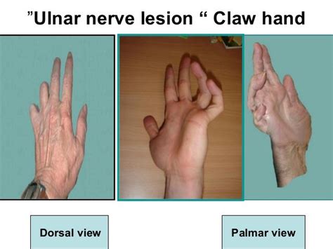 Lesion Of Ulnar Nerve Bilateral Upper Limbs