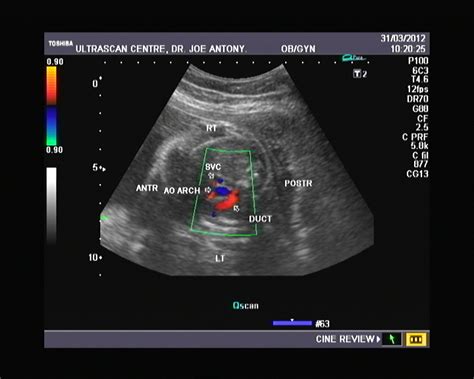 Ultrasound And Color Doppler Videos The Ductus And 3 Vessel View In 30
