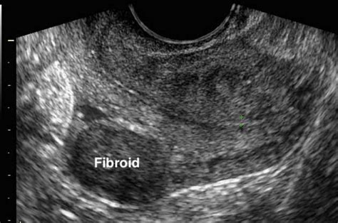 Uterine Fibroids Symptoms Causes And Treatments Options Delhi India