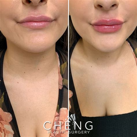 Juvéderm Ultra Plus Lip Filler Lip fillers Lip augmentation Juvederm