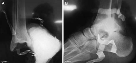 Open Axial And True Vertical Ankle Dislocation Without Malleolar