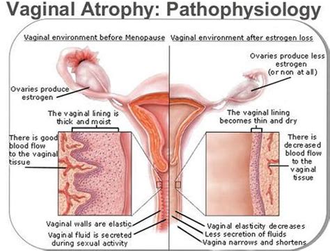 Find out what each endometriosis stage really means, and learn more about endometriosis experts use stages to classify endometriosis by severity, but the stage doesn't always correspond to. WOMENS HEALTH: GENITOURINARY SYNDROME OF MENOPAUSE