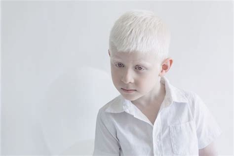 Can Albino People Dye Their Hair Debunking Myths And Sharing Hair Care