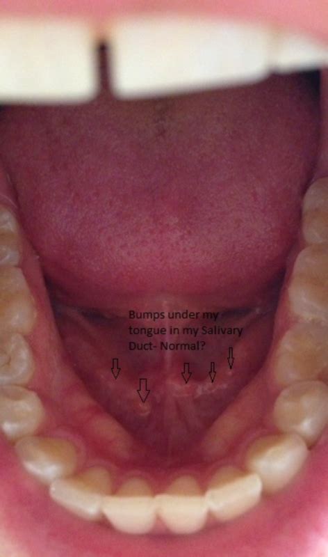 5 Small Bumps Under My Tongue Along My Salivary Duct What Thread