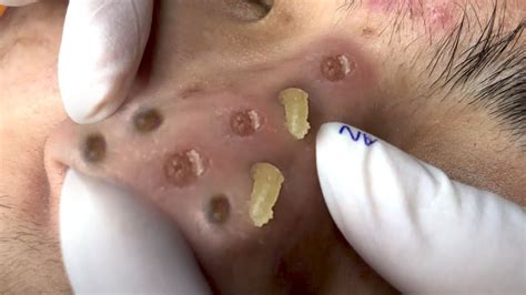 Massive Blackheads On Nose And Lips Clean Giant Blackheads On Nose