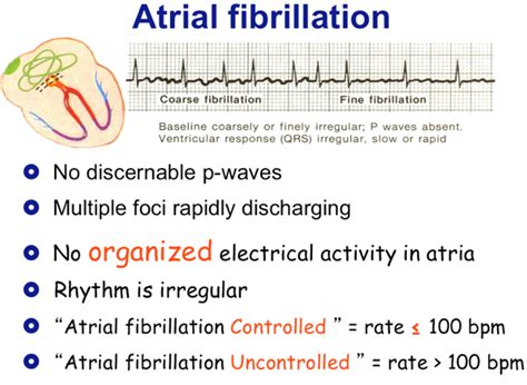 Atrial Fibrillation Atrial Flutter Vs Atrial Fibrillation