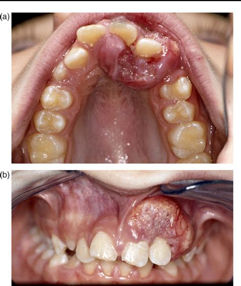 Figure 1 From Oral Squamous Cell Carcinoma In Children