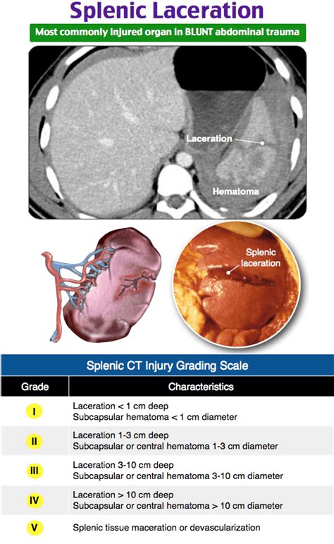 Splenic Laceration Most Commonly Injured Organ In Grepmed