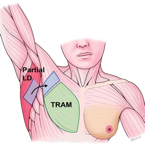PDF Reconstruction Of Unexpected Huge Chest Wall Defect After