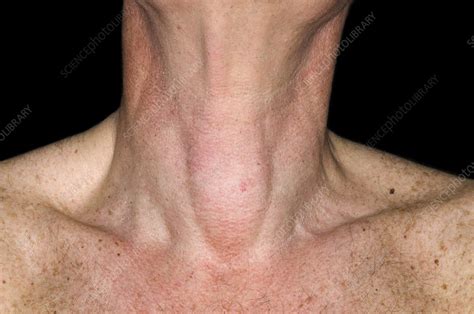 Cystic Nodule On The Thyroid Gland Stock Image C0168195 Science