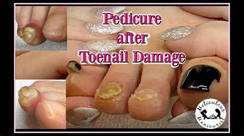 👣 Pedicure Lessons Online For Damaged Toenails 👣👍 Youtube