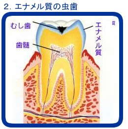 (this etymology is missing or incomplete. 虫歯・歯槽膿漏 of 近藤歯科 広島県三原市の痛くない歯の治療