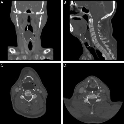 Lipoma Of Right Pyriform Sinus Bmj Case Reports