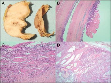 A Macroscopic Examination Of The Gastric Duplication Cyst Wall