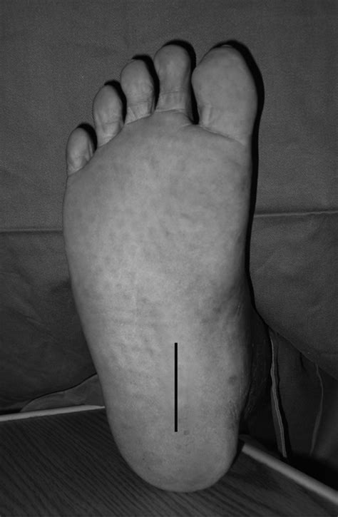 The Myofascial Compartments Of The Foot Bone And Joint