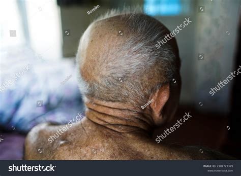 Hair Loss Men Bald Head Old Stock Photo 2181727329 Shutterstock