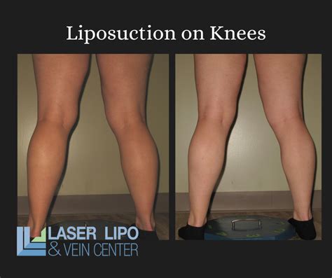 Knee Liposuction Cost Of Lipo On Knees St Louis Liposuction