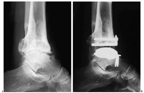 artroplastia total de tobillo primeros 25 casos revista española de cirugía ortopédica y