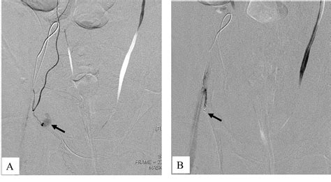 Safety And Efficacy Of Transcatheter Arterial Embolization For