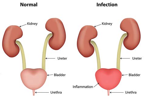 An Overview Of Urinary Tract Infection Uti Urology Specialist