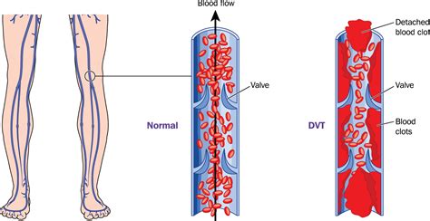 What Is Deep Vein Thrombosis Dvt Agency For Services To Medical Science