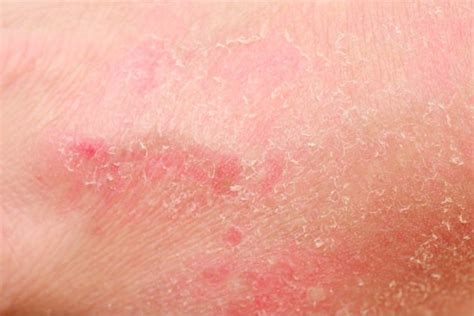 Treatment Of Eczema Complications