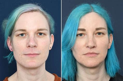Facial Feminization Surgery Expertise In Europe Pass Clinic