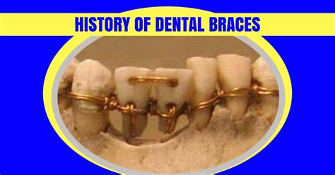 A Peek Into The History Of Braces Expert Dental Care