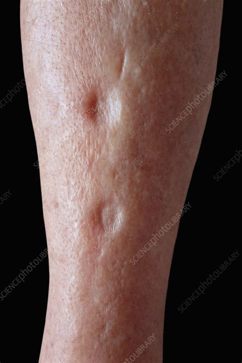 Lymphoedema Of The Leg Stock Image C0402305 Science Photo Library