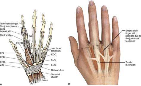 Extensor And Flexor Tendon Injuries In The Hand Wrist And Foot