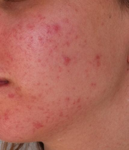 Small Bumps All Over My Face Help Please Pics General Acne