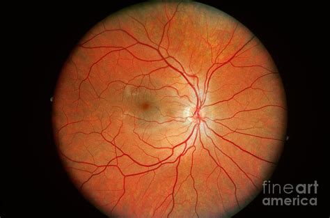 Normal Retina Photograph By Science Source Pixels