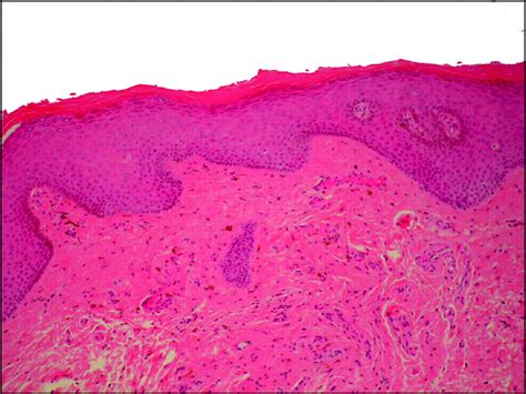 Sebaceous Hyperplasia Of The Vulva A Clinicopathological Case Report