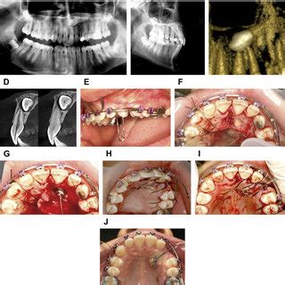 It primarily focuses on improved dental aesthetics in. (PDF) Surgical Treatment of Impacted Canines: What the ...