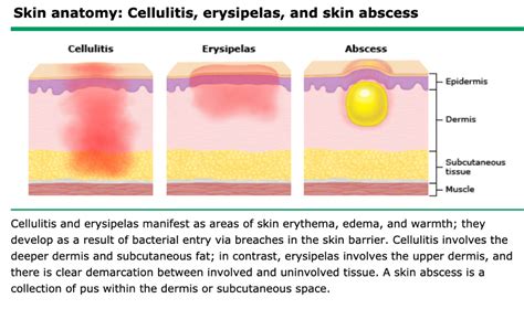 Cellulitis Erysipelas Impetigo Markenzie Jean Baptiste Physician