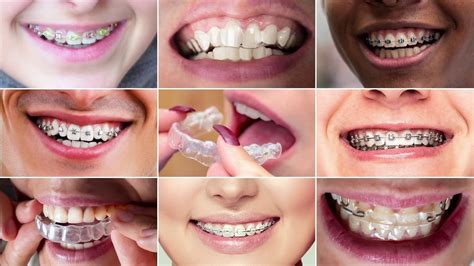 Invis Is The Answer For Your Child Invisalign The Clear Alternative