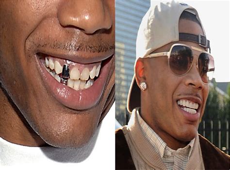 Nene Teeth Before And After Celebrity Teeth What They Looked Like