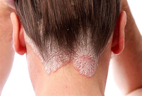 Pictures Of Skin Rashes Lovetoknow Health And Wellness