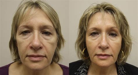 Face Workouts To Gain A Diy Natural Facelift Obtain A Non Invasive