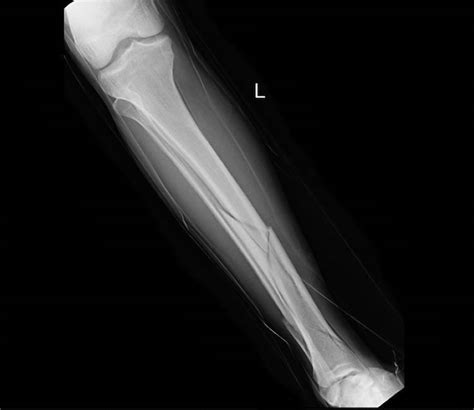 Lower Limb Fractures Orthopaedics And Trauma London