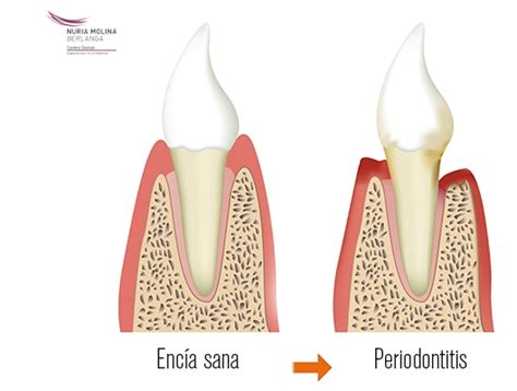 Periodontitis O Piorrea Centre Dental Nuria Molina Berlanga