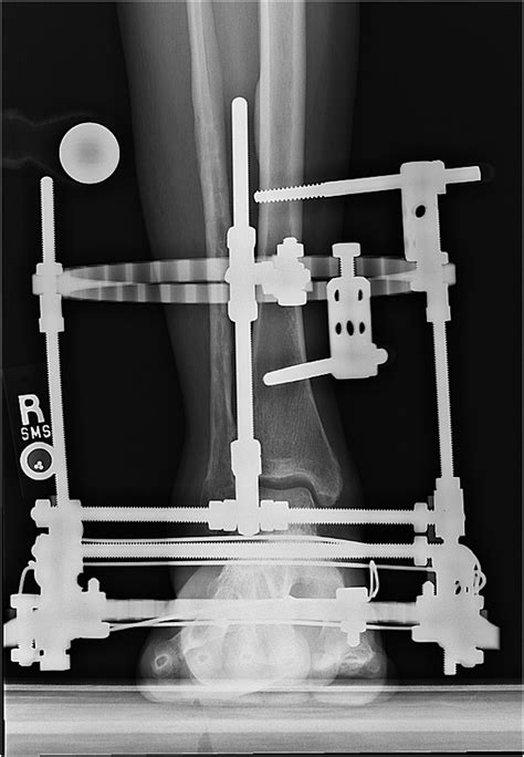 Ankle Distraction Arthroplasty Ada A Brief Review And Technical