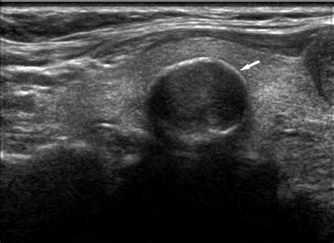 Differentiation Of Thyroid Nodules With Macrocalcifications Kim