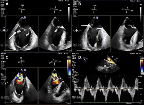 Two Dimensional Tee Mitral Commissural View With Biplane Imaging