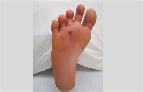 How To Spot Diabetic Foot Complications Early Life