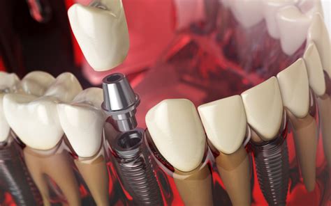 Implantes O Puentes Dentales Estas Son Sus Diferencias Clinica